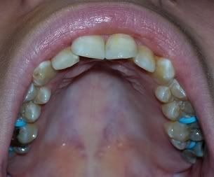 bottom molars